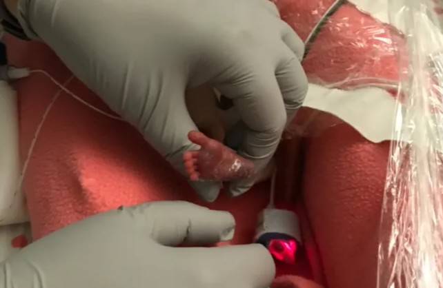 Médico mostra tamanho do pé de uma das bebês (Foto: Reprodução/guinnessworldrecords.com)