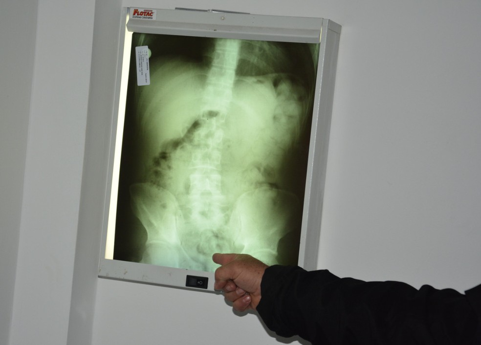 Radiografia mostrou as cápsulas de cocaína no estômago do venezuelano, preso no Aeroporto do Recife, na segunda-feira (27) (Foto: Polícia Federal/Divulgação)