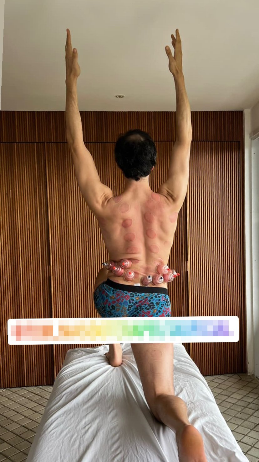 Mateus Solano posta foto de cueca durante sessão de ventosaterapia - Quem |  QUEM News