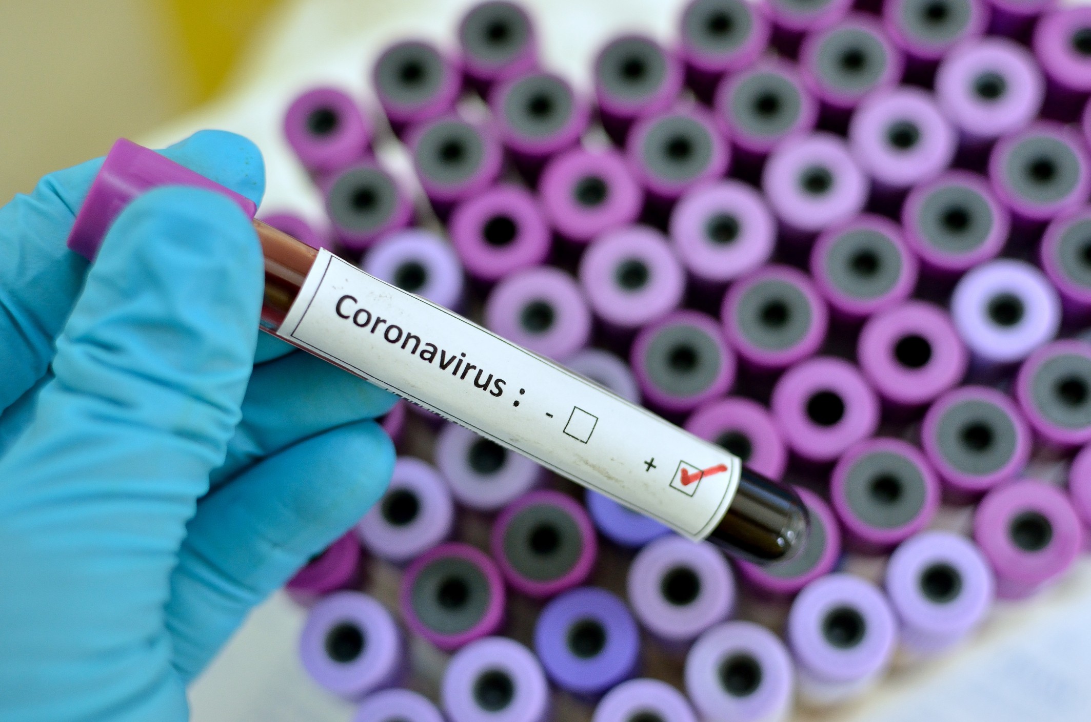 Teste positivo do coronavírus (Foto: iStock / Getty Images Plus)
