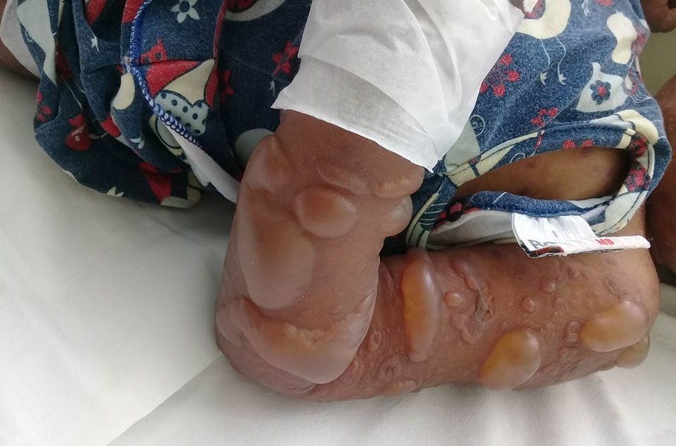 Bolhas tomaram conta do corpo da menina assustaram família de Bertioga, SP (Foto: Arquivo Pessoal)