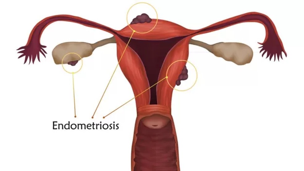 A endometriose é a presença de tecido do revestimento do útero - o endométrio - fora do útero — Foto: Getty Images