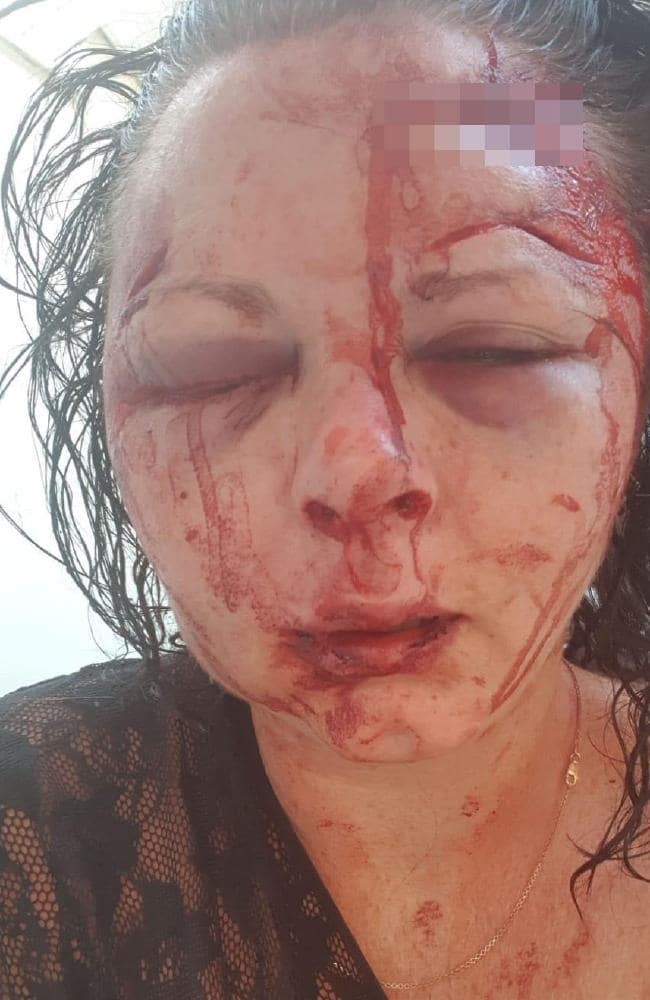 Emma Higginson sofreu ataque na Turquia  (Foto: The Sun/ Reprodução)