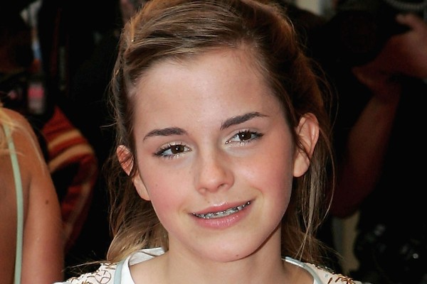 Crescer sob os holofotes tem suas desvantagens: Emma Watson usou aparelho quando tinha 15 anos de idade e não escapou dos registros da fase (Foto: Getty Images)
