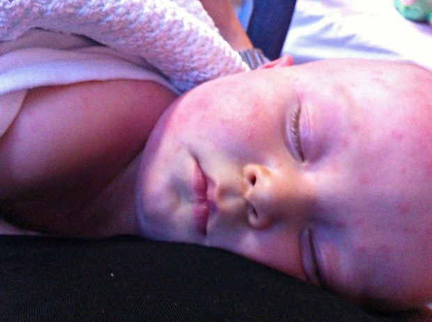 Bebê reação alérgica (Foto: Reprodução)