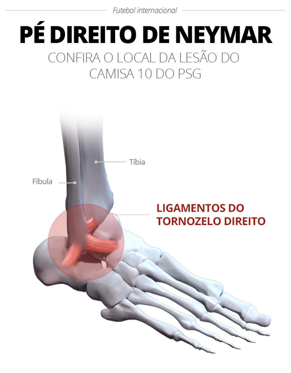 Lesão no é no mesmo tornozelo que Neymar machucou durante a última Copa — Foto: infoesporte