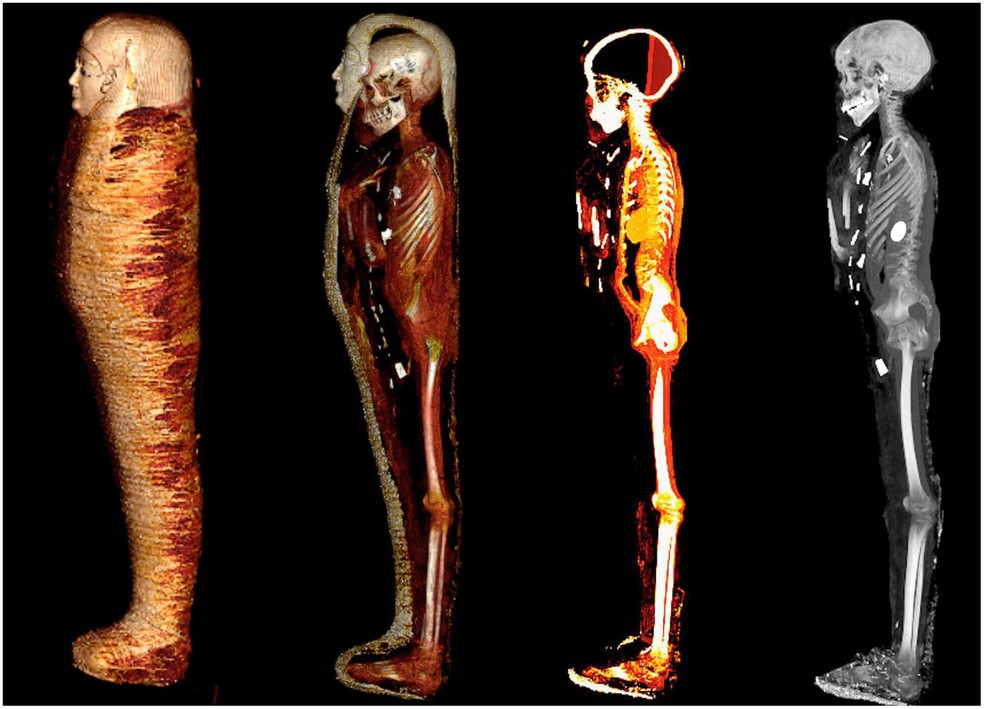 Imagens de tomografia computadorizada do corpo da múmia batizada de "Menino de Ouro". Ela foi encontrada em 1916 e permaneceu armazenada em um porão no Museu do Cairo, no Egito. — Foto: Frontiers in Medicine/Divulgação