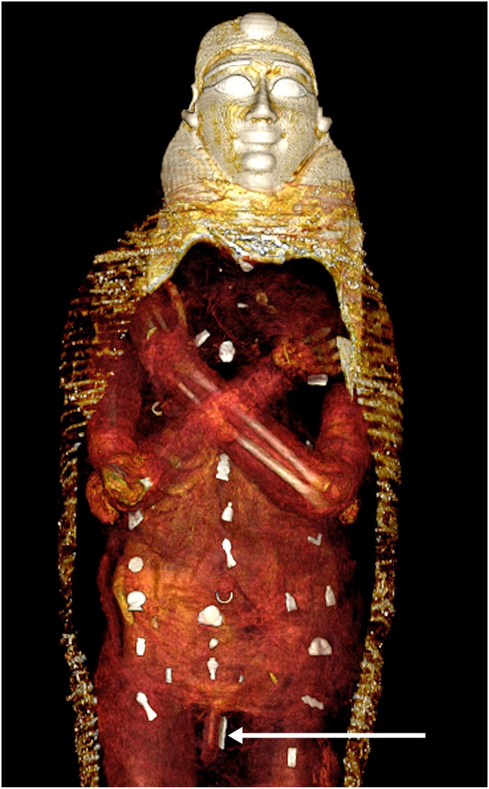 Tomografia mostra posicionamento dos amuletos no corpo do "Menino de Ouro" — Foto: Frontiers in Medicine/Divulgação