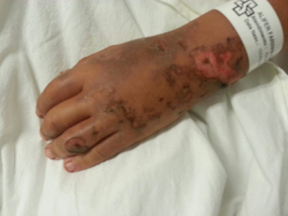 Menino de 11 anos teve ferimentos em diversas partes do corpo aps choque (Foto: Danbia Rolon/Arquivo Pessoal)