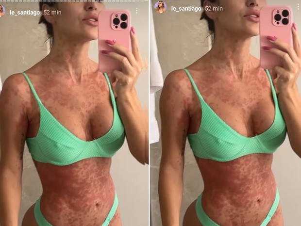 30 de maio de 2022: Letícia Santiago mostra manchas pelo corpo (Foto: Reprodução/Instagram)