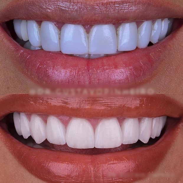 O antes e depois dos dentes de Simaria (Foto: Reprodução/Instagram)