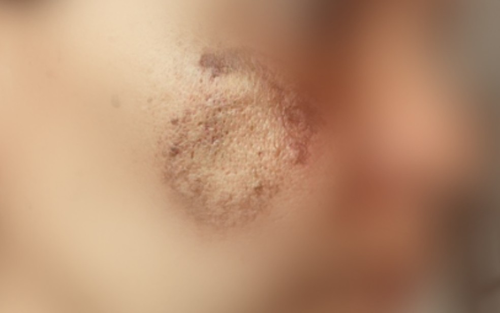 Estudante foi mordida no rosto durante agressão, em Trindade, Goiás — Foto: Reprodução/arquivo pessoal