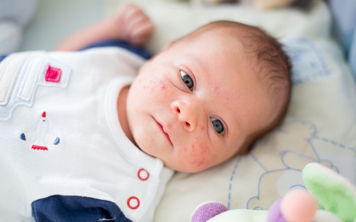 Brotoejas No Bebe O Que Sao E Como Tratar Revista Crescer Saude