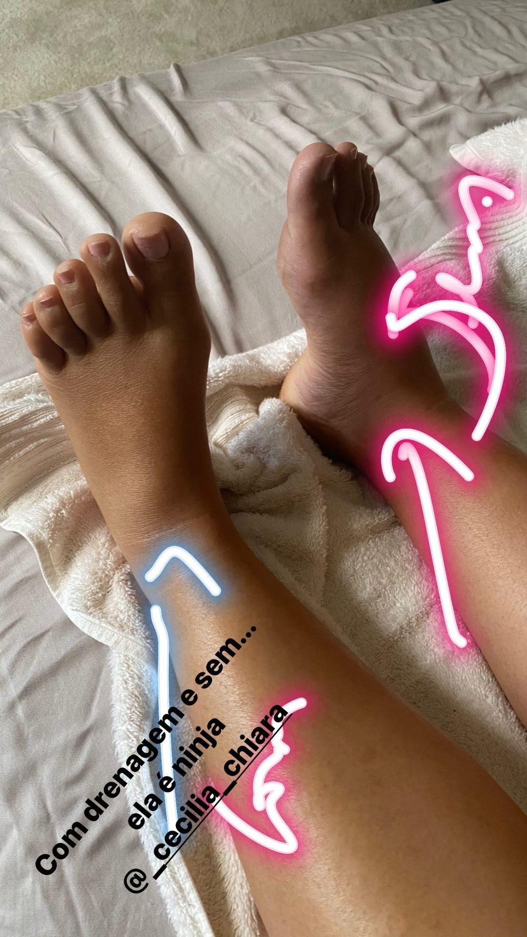 Simone mostra diferença nos pés depois (esquerdo) e antes (direito) de drenagem (Foto: Reprodução/Instagram)