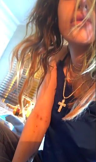 A atriz Bella Thorne com o braço com marcas de agulha (Foto: Instagram)