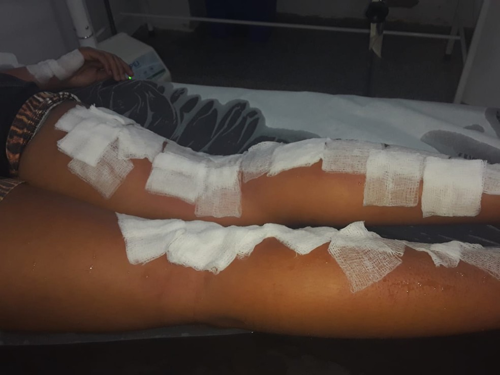 Menina teve queimaduras de 1° e 2° graus nas pernas, em Porto Velho — Foto: Arquivo Pessoal