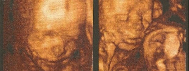 Ultrasson de gêmeos e um deles deve passar por cirurgia (Foto: Reprodução)