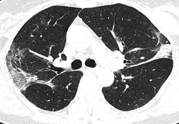 Tomografia computadorizada de uma mulher de 45 anos com diagnóstico de coronavírus na China (Foto: Radiological Society of North America (RSNA))