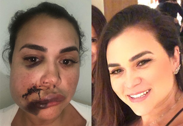 Milka Borges fica com rosto desfigurado após agressão (Foto: Reprodução/Instagram)