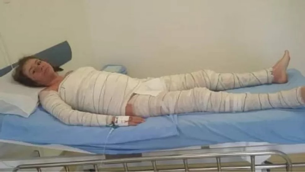 Durante sua crise mais severa, Caroline precisou ter o corpo enfaixado. — Foto: Arquivo pessoal via BBC