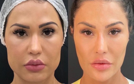 Gracyanne Barbosa mostra antes e depois de procedimentos no rosto