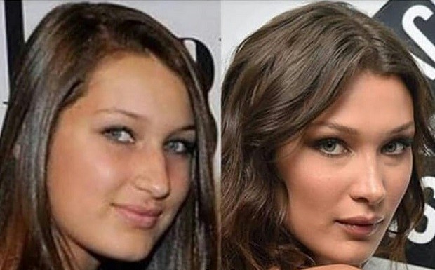 Bella Hadid, antes e depois (Foto: Instagram/ Reprodução)