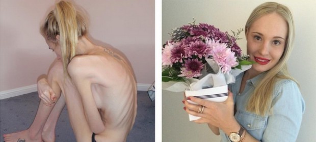 Jovem com anorexia se recuperou após ouvir que tinha apenas 48 horas de vida (Foto: Reprodução/Instagram)
