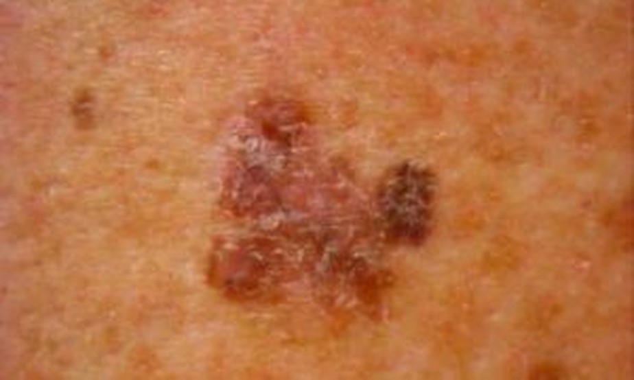 Cuidados com a saúde: Melanoma | Compromisso com a Ciência e com o seu ...