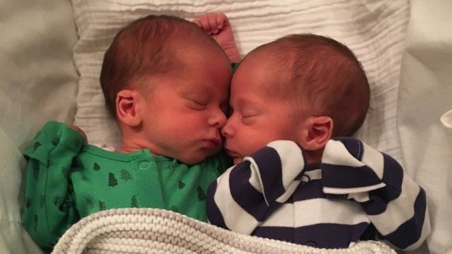 Os gêmeos quando nasceram (Foto: Divulgação Hospital Geral de Kettering)