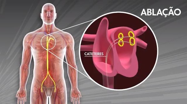 O Que E Miocardite Causas Sintomas E Tratamentos Para A Doenca Que Atinge Muitos Atletas Saude Ge