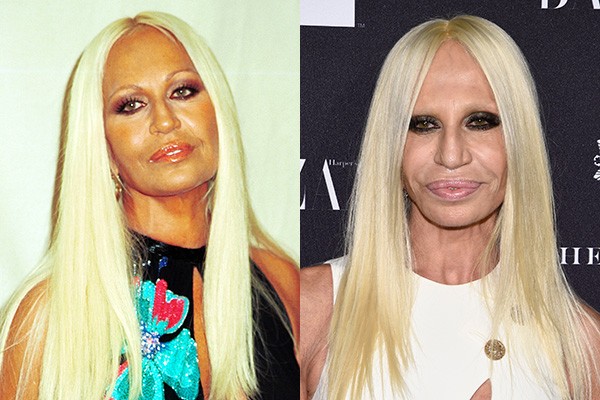 Donatella Versace tem presença constante em listas de transformação. A estilista de 58 anos teve vários procedimentos feitos em seu rosto - e há boatos de que ela tenha passado por sessões de bronzeamento. (Foto: Getty Images)