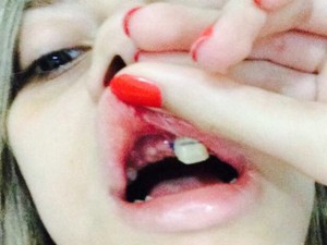 Larissa perdeu dentes no acidente (Foto: Larissa Magalhães / Arquivo Pessoal)