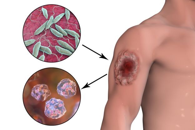 Ilustração mostra uma ferida causada por leishmaniose – em cima, os parasitas que causam a doença e, abaixo, as células humanas infectadas (Foto: Getty Images/BBC)
