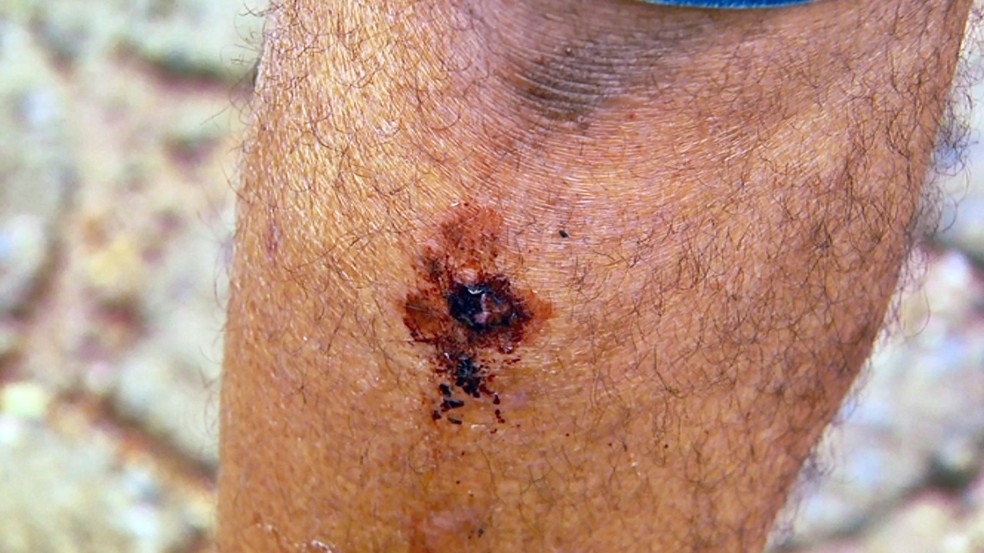 Vereador mostra ferimentos após abordagem da PM em Muzambinho — Foto: Reprodução EPTV