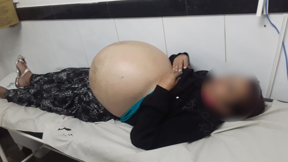 Mulher com barriga 'gigante' retira 25 litros de líquido e busca tratamento