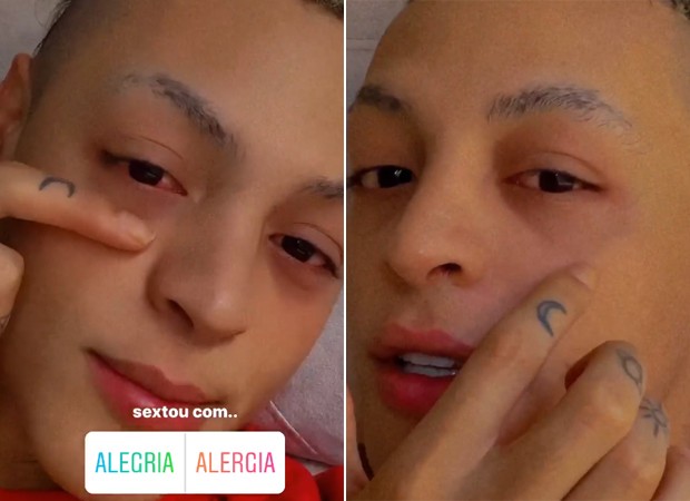 Pabllo Vittar mostra alergia nos olhos (Foto: Reprodução / Instagram)