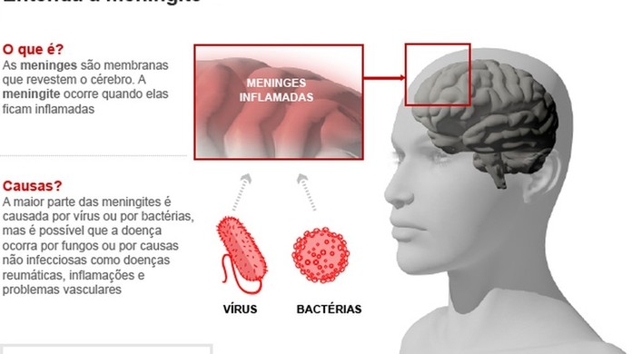 O Que E Meningite E Seus Sintomas