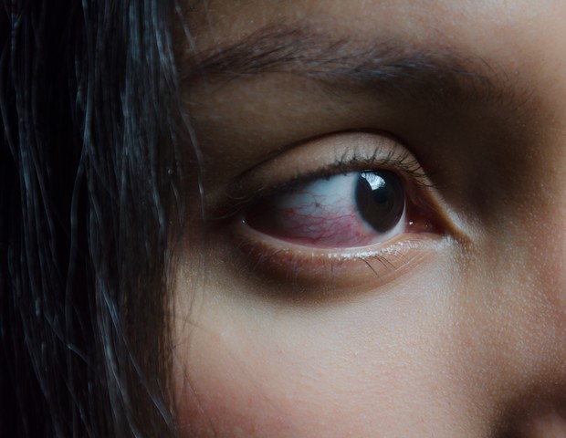Olhos vermelhos podem ser sinal de coronavírus (Foto: Getty)