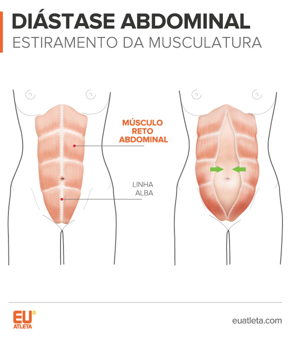 Diastase Tem Jeito Exercicios Em Casa Podem Resolver O Problema Das Mamaes Saude Ge