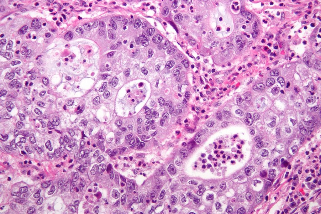 Micrografia de um câncer cervical (Foto: Wikimedia Commons)