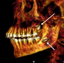 Arcada dentária da múmia, pela qual visualizou-se os sisos não irrompidos e foi possível estimar a idade do jovem embalsamado — Foto: Divulgação/SN Saleem, SA Seddik, M el-Halwagy