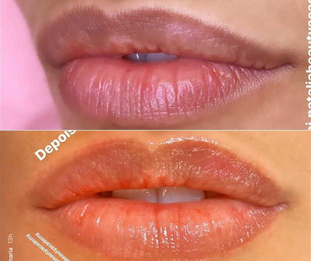 Lábios de Simaria após revitalização (Foto: Reprodução/Instagram)