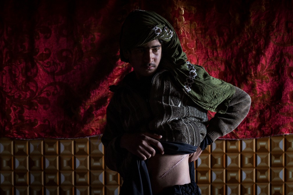 4 de fevereiro - Afego que vendeu seu rim na tentativa de salvar sua famlia da fome, mostra as cicatrizes da operao dentro de sua casa em Sayshanba Bazaar, no distrito de Injil, na provncia de Herat — Foto: Wakil Kohsar/AFP