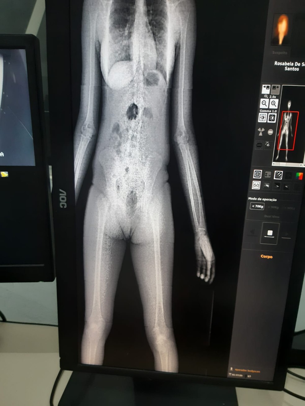 Mulher é detida ao entrar em presídio com maconha escondida — Foto: Ascom/Seris