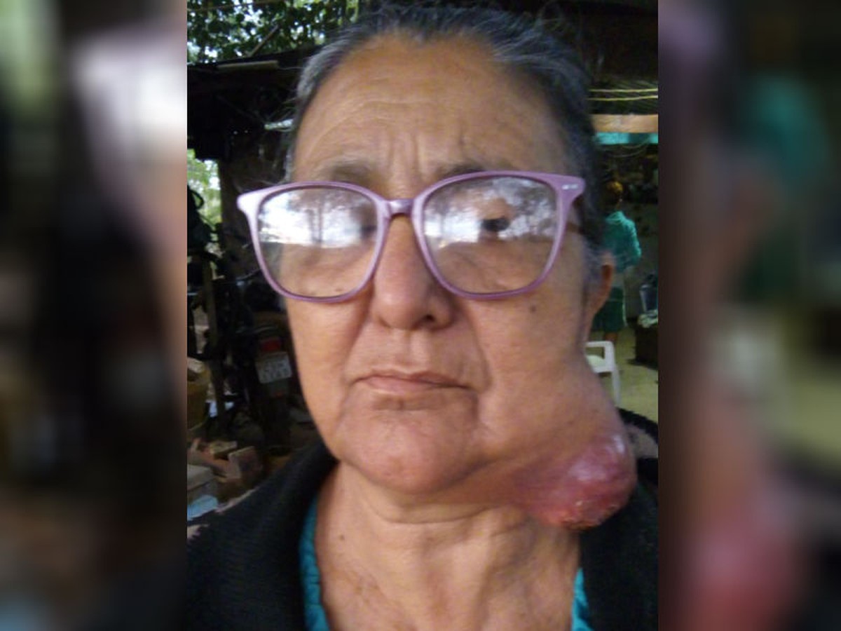 Voltarei A Viver Diz Costureira Apos Cirurgia Para Retirar Tumor Gigante Do Pescoco Sorocaba E Jundiai G1