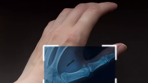 Brasileiros relatam como é ter chip implantado na mão