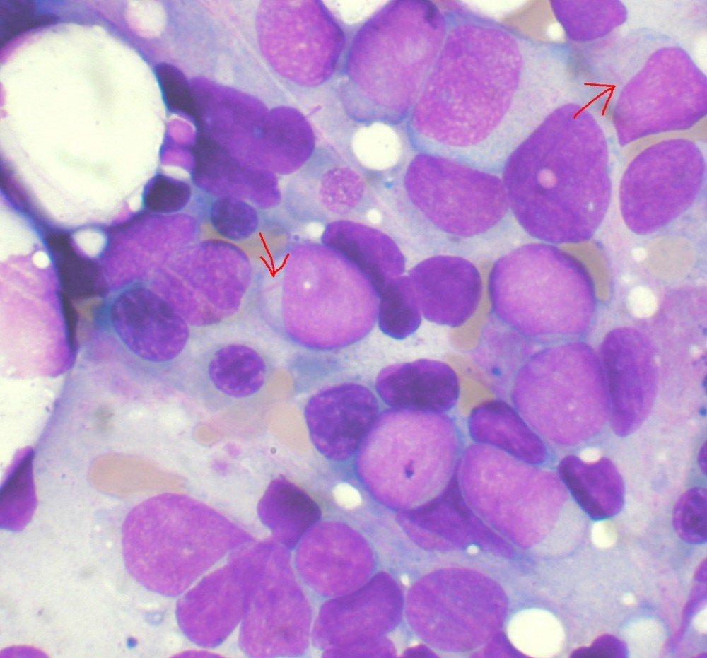 Cientistas da USP identificam proteína associada ao agravamento da leucemia (Foto: Wikimedia Commons)