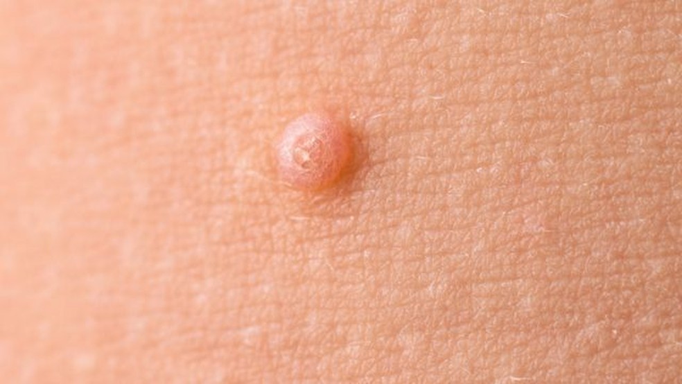 Molusco contagioso — Foto: Getty Images via BBC