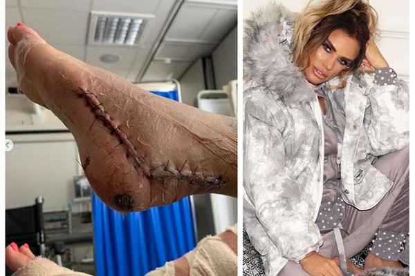 Uma das fotos compartilhadas pela celebridade britânica Katie Price mostrando seu pé pós-procedimento cirúrgico (Foto: Instagram)