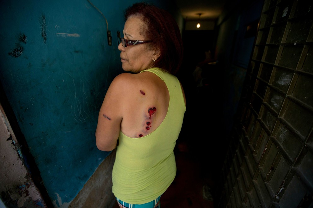 Moradora do bairro de Cotiza, em Caracas, mostra ferimentos causados por balas de borracha disparadas pela Guarda Nacional Bolivariana Venezuelana durante um protesto na terça-feira (22)  — Foto: Fernando Llano/ AP